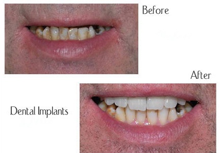 Dental Implants