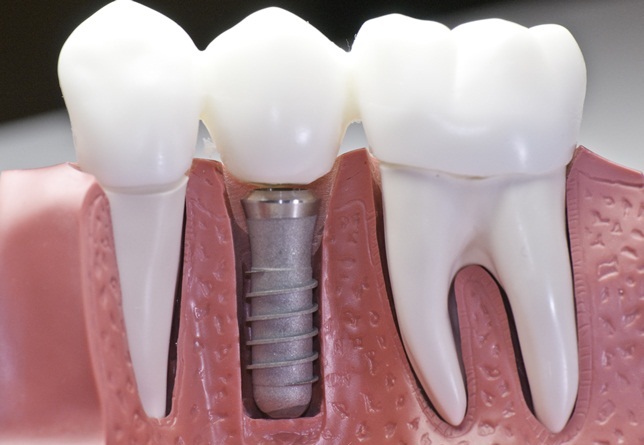 Dental Implants