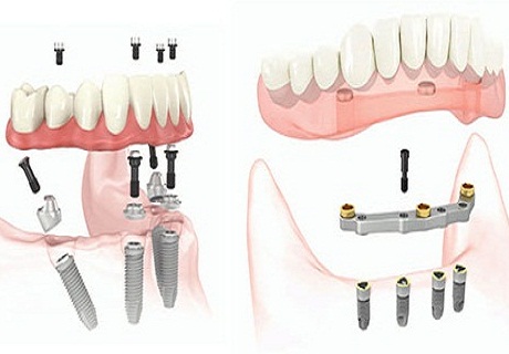 Dental Implants